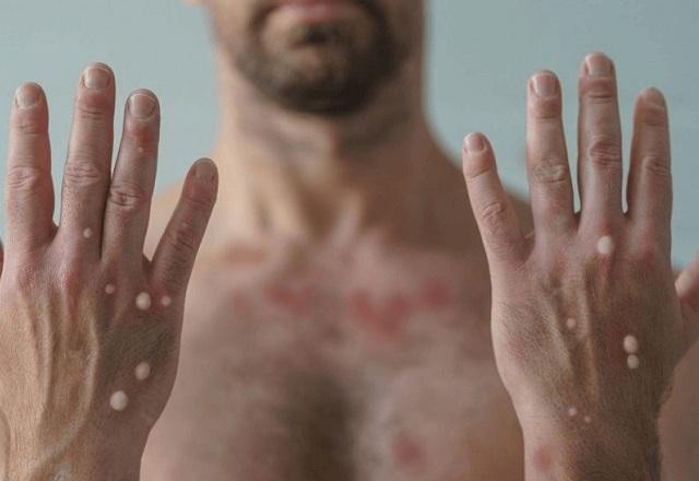 Imagem da noticia Brasil ultrapassa marca de 1,5 mil casos de Mpox em 2024