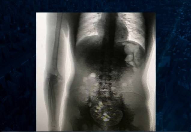 Imagem da noticia Preso é flagrado com 8 celulares, chips e carregadores dentro do corpo em MT