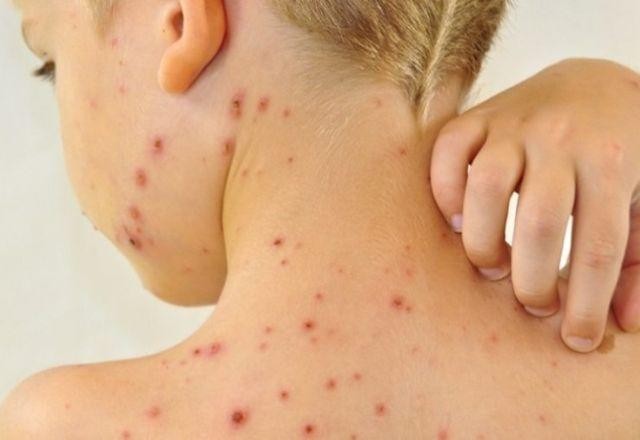 Imagem da noticia Sem novos casos, Brasil sai da condição de país endêmico para o sarampo