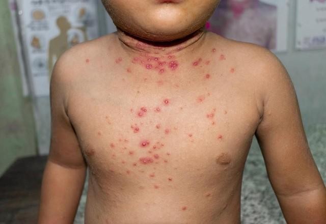 Saúde investiga cinco casos de varíola dos macacos no Rio de Janeiro