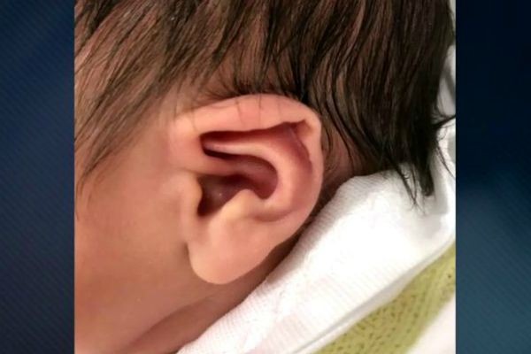 Imagem da noticia Tratamento sem cirurgia para orelhas de abano é esperança de muitos pais