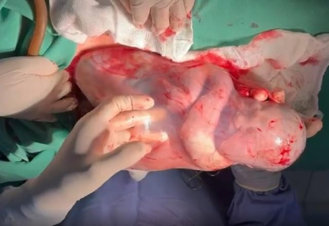 Bebê nasce empelicado em Goiás e médico faz cócegas para acordá-lo