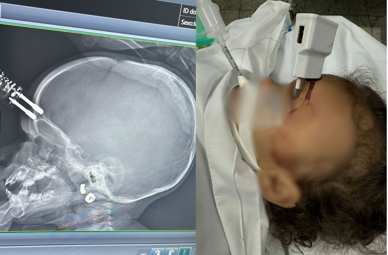 Imagem da noticia Bebê de 1 ano cai da cama e fica com carregador cravado na testa em MG