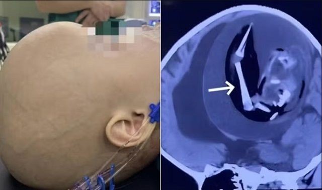 Imagem da noticia "Gêmeo parasita": bebê de 1 ano morre com um feto dentro de seu crânio; entenda 