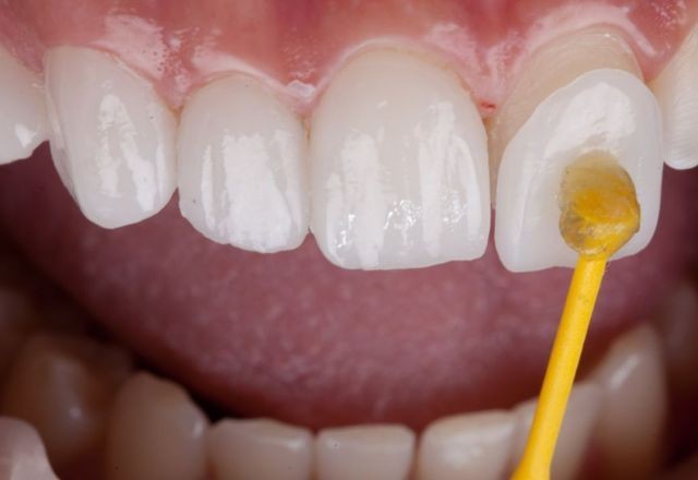 Imagem da noticia Venda de resinas em e-commerce é alvo de denúncia do Conselho de Odontologia