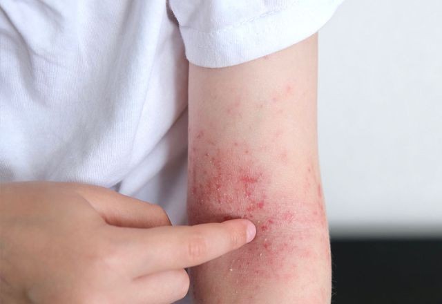 Imagem da noticia SUS inclui 3 novos medicamentos no tratamento de dermatite atópica