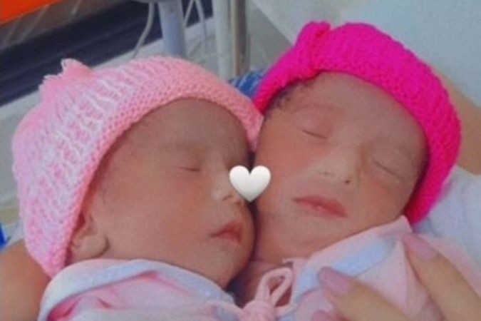 Imagem da noticia Gêmeas siamesas ligadas por um só coração morrem em hospital de Brasília