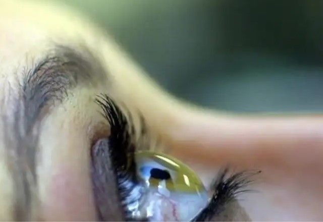 Imagem da noticia Glaucoma: monitoramento evitou cegueira em 300 mil brasileiros
