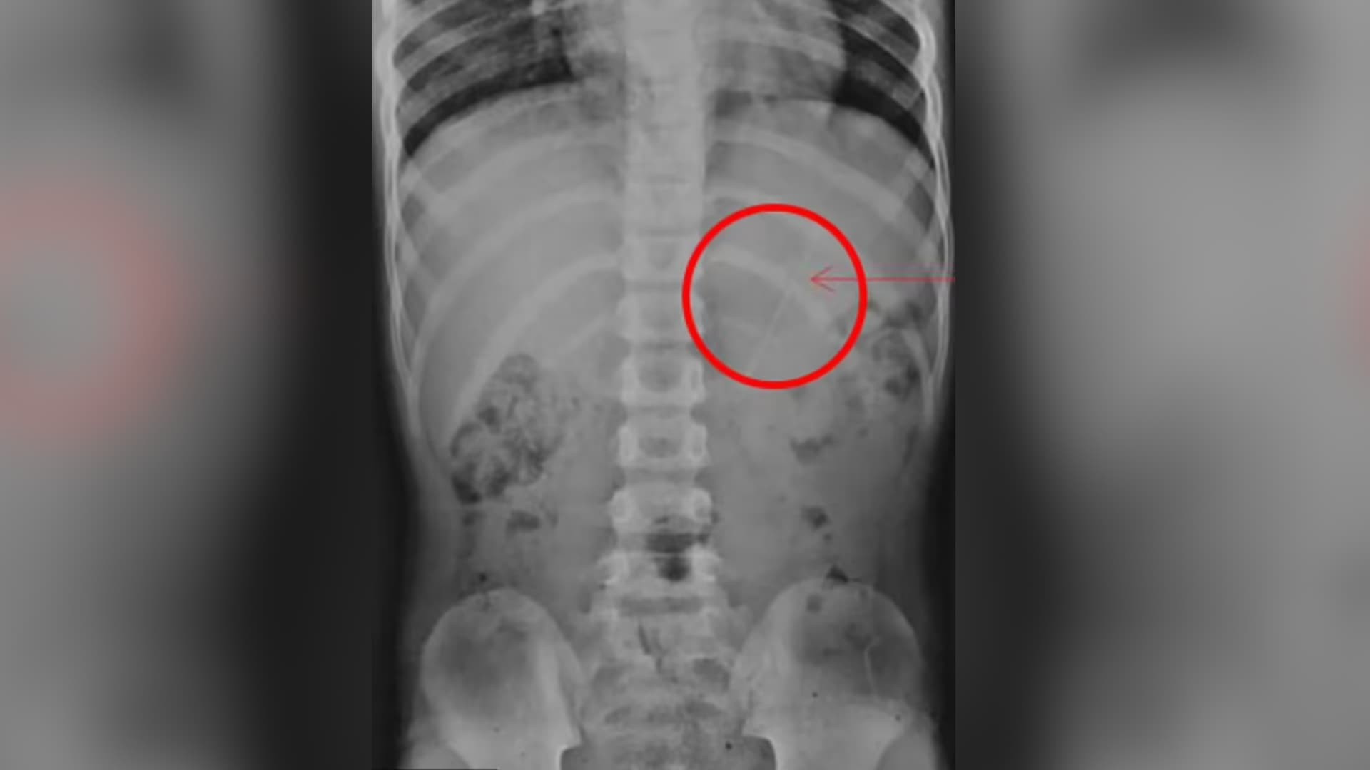 Imagem da noticia Menino de 7 anos engole lápis inteiro de 10 cm; veja fotos