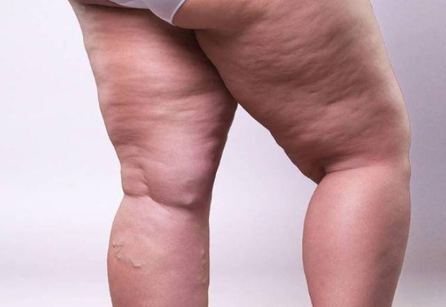 Entenda o que é "lipedema", doença que atinge 5 milhões de brasileiras