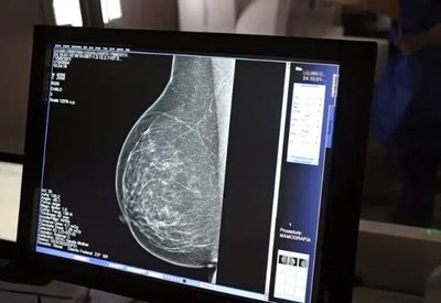 Mamografia sem dor: inovação tecnológica promete exame mais confortável e preciso