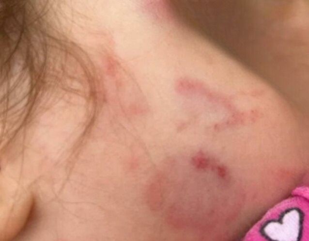 Imagem da noticia Pai acusa creche de omissão após bebê voltar para casa com marcas de mordida no Rio