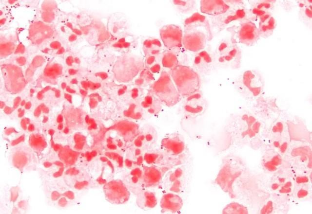 Imagem da noticia Criança de 5 anos morre de meningite meningocócica em SP