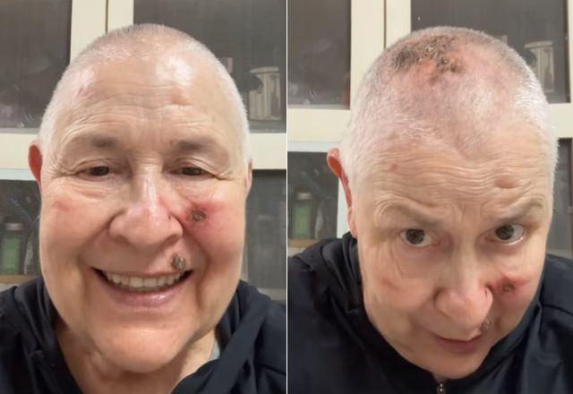Imagem da noticia Câncer de pele: Monja Coen revela que está em tratamento; veja como se prevenir
