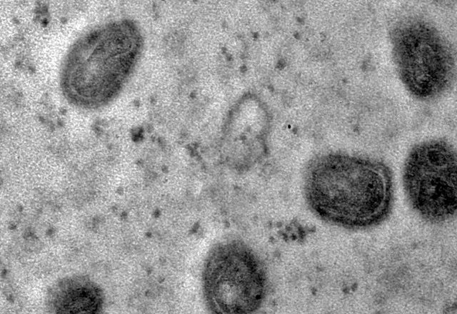 Imagem da noticia Mundo ultrapassa marca de 100 mil casos de Mpox