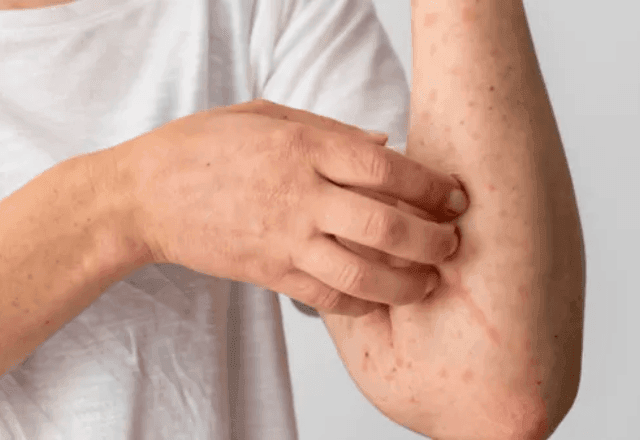 Imagem da noticia Bahia confirma dois casos de Mpox em 2026