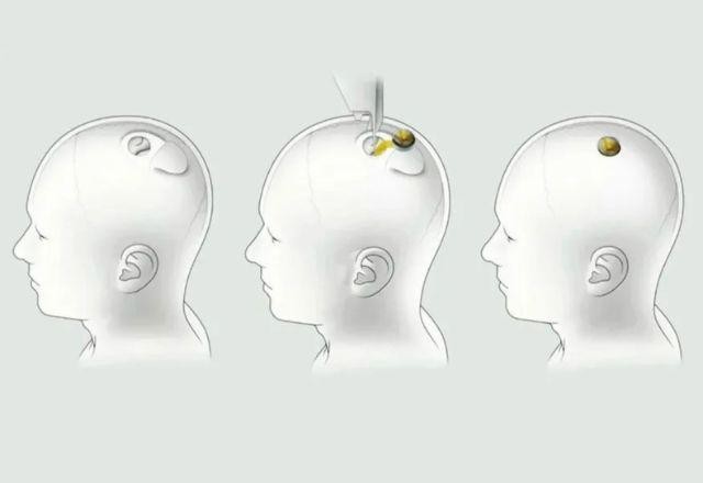 Imagem da noticia Neuralink consegue autorização da FDA para testar implantes em cérebros humanos