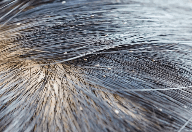 Imagem da noticia Volta às aulas: como lidar com infestação de piolhos entre crianças