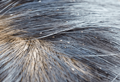 Volta às aulas: como lidar com infestação de piolhos entre crianças