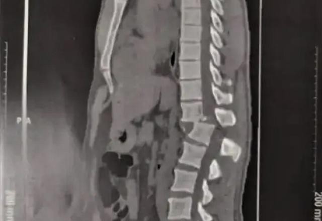 Imagem da noticia Aluno que fraturou a coluna em aparelho na academia vai receber alta
