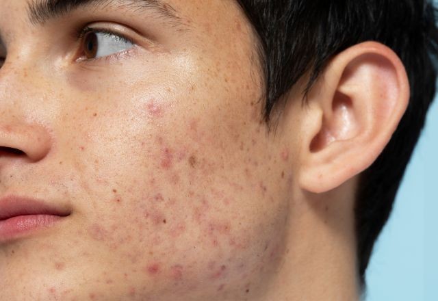 Imagem da noticia Acne: pesquisadores desenvolvem tratamento que modifica bactéria que causa espinhas