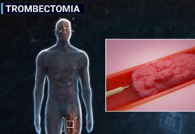 Imagem da noticia Médicos cobram incorporação imediata pelo SUS da trombectomia