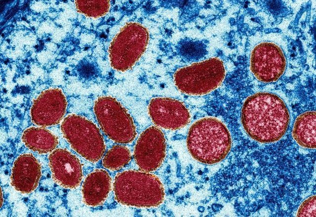 Imagem da noticia Brasil chega a 945 casos de Mpox em 2024 e ultrapassa marca de 2023