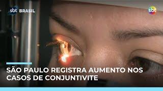 Casos de conjuntivite crescem 36% em São Paulo após queda durante a pandemia Casos de conjuntivite crescem 36% em São Paulo após queda durante a pandemia