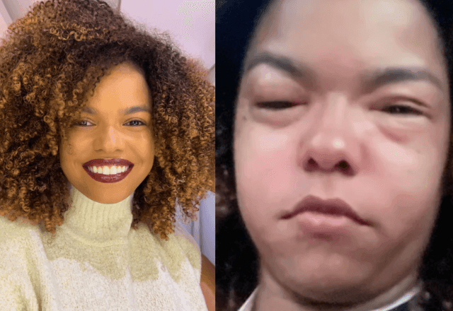 Imagem da noticia Podemos desenvolver alergias alimentares já adultos, como Jeniffer Nascimento?