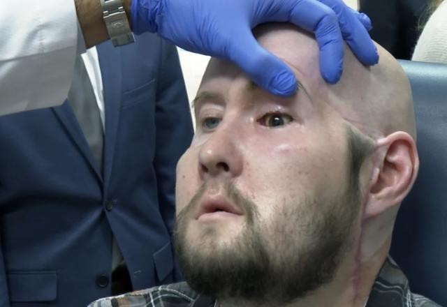 Imagem da noticia Cirurgiões em Nova York anunciam o primeiro transplante de olho inteiro do mundo