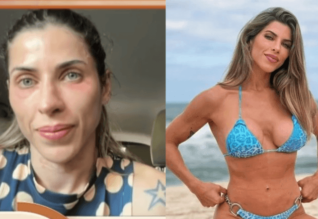 Imagem da noticia Hidrogel de ex-panicat se desloca do bumbum para as costas; quais são os riscos?