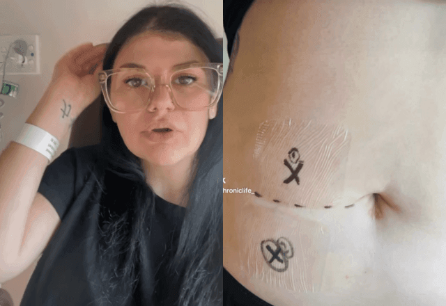 Imagem da noticia Australiana descobre ter cinco órgãos a mais no corpo após cólica intensa; como isso acontece?