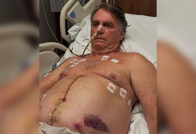 Imagem da noticia Bolsonaro teve "drenos do abdômen retirados" e passou por "troca do curativo" da cirurgia, diz boletim