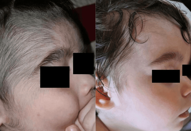 Imagem da noticia O que é o Minoxidil, produto anticalvície responsável pelo crescimento de pelos em bebês