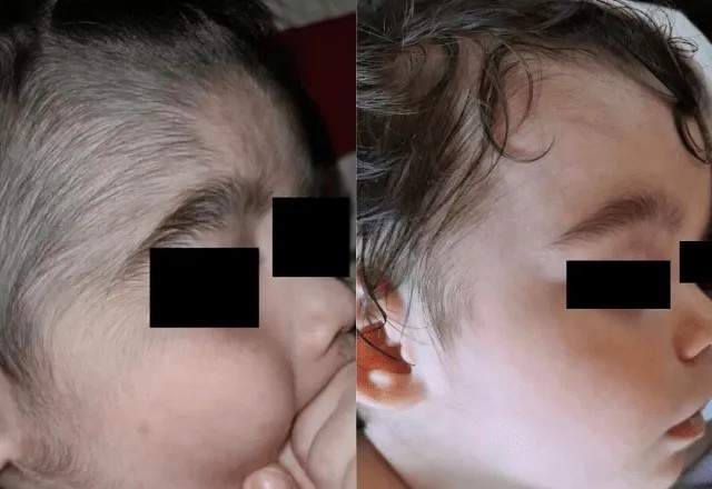 Imagem da noticia Anvisa alerta para risco de 'sindrome do lobisomem' em bebês após contato com minoxidil; entenda