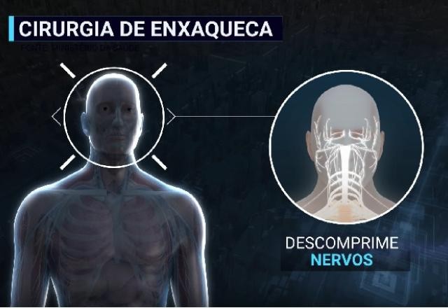 Imagem da noticia Cirurgia de descompressão de nervos: esperança para quem sofre com a enxaqueca