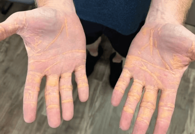 Imagem da noticia Entenda o que é xantelasma, condição que faz colesterol "vazar" pelo corpo