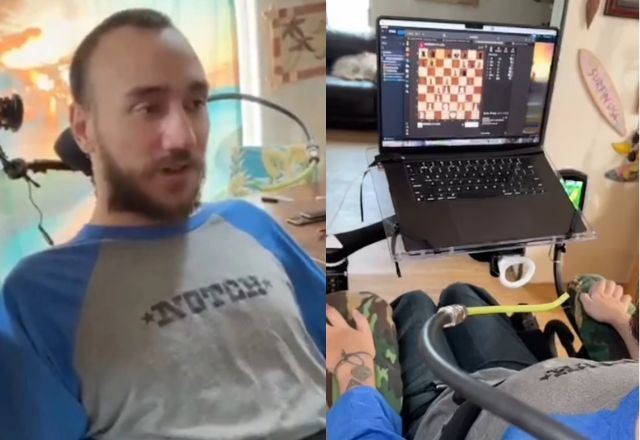 Imagem da noticia Paciente com implante cerebral da Neuralink, de Elon Musk, sofre complicações