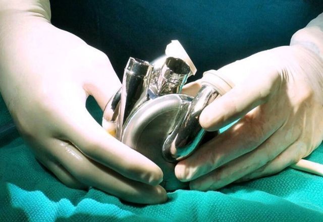 Imagem da noticia Australiano vive 100 dias com coração artificial de titânio em teste inovador