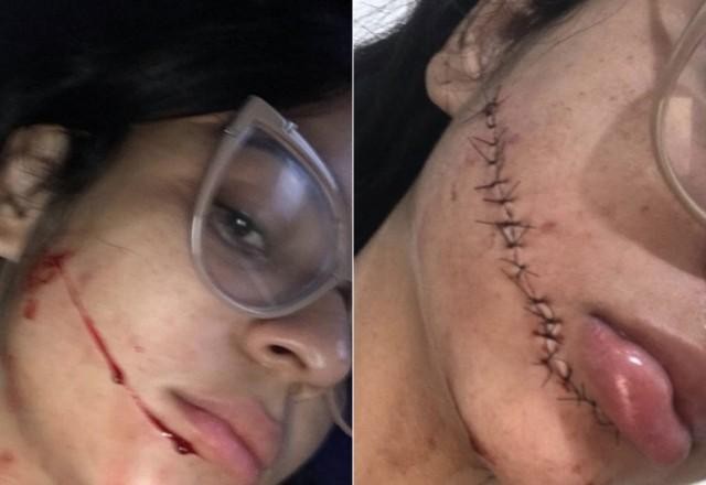 Imagem da noticia Jovem tem rosto cortado durante viagem de ônibus e leva 18 pontos