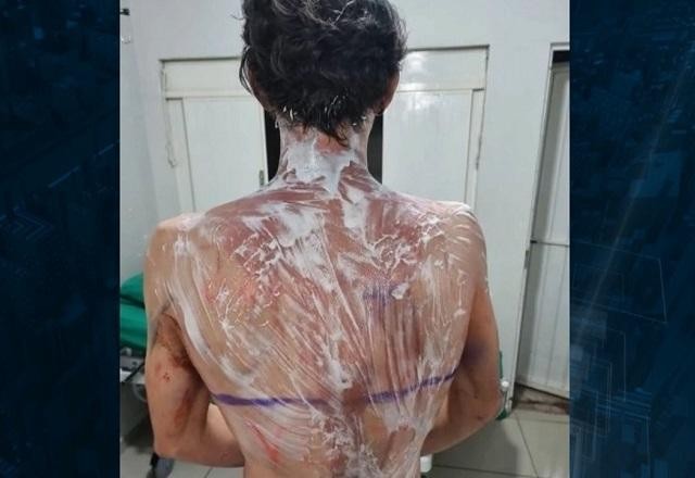Imagem da noticia Calouros de veterinária sofrem queimaduras durante "trote" violento