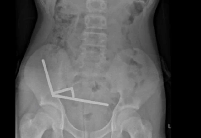 Imagem da noticia Adolescente perde parte do intestino após engolir cerca de 100 ímãs