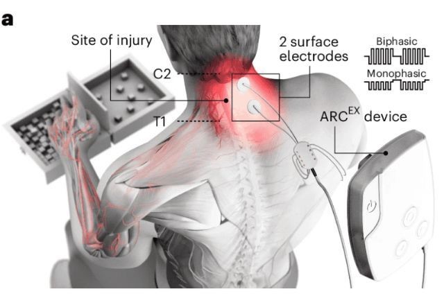 Imagem da noticia Dispositivo faz paraplégicos recuperarem os movimentos das mãos e dos braços