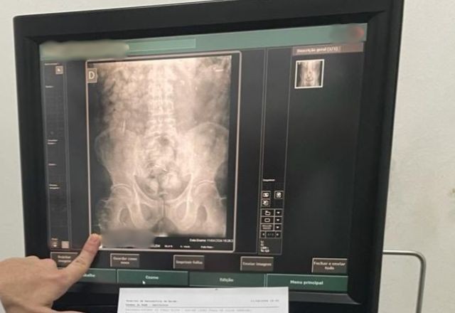 Imagem da noticia Venezuelano é preso e levado para o hospital com 150 cápsulas de cocaína no estômago