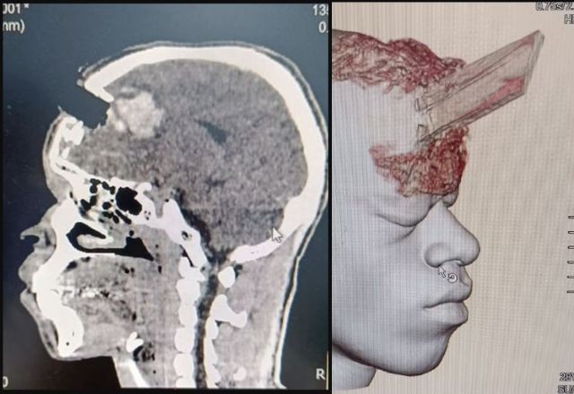 Imagem da noticia Estaca de madeira perfura cabeça de homem; cirurgia de retirada é considerada um sucesso