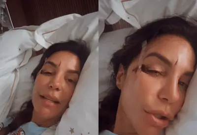 Ivete Sangalo sofre acidente doméstico e mostra machucados no rosto Ivete Sangalo sofre acidente doméstico e mostra machucados no rosto