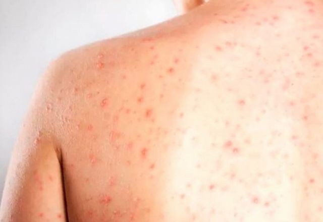 Imagem da noticia Cidade de SP confirma segundo caso importado de sarampo