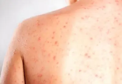 Cidade de SP confirma segundo caso importado de sarampo Cidade de SP confirma segundo caso importado de sarampo