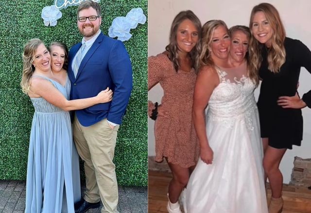 Imagem da noticia Abby e Brittany: como funciona o corpo das gêmeas siamesas unidas pela cabeça?