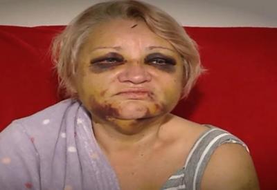 Homem não aceita fim do namoro e deixa ex desfigurada Homem não aceita fim do namoro e deixa ex desfigurada